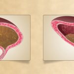Natural Treatment for Overactive Bladder