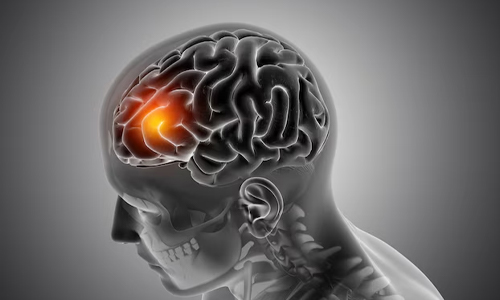About Brain Herniation