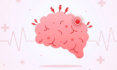 Stroke