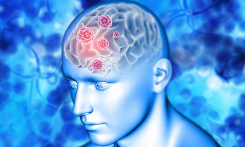 Hydrocephalus causes Brain Herniation
