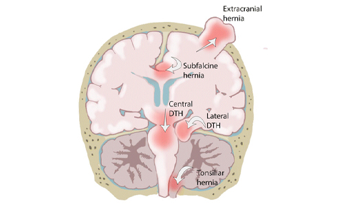 Brain Herniation types