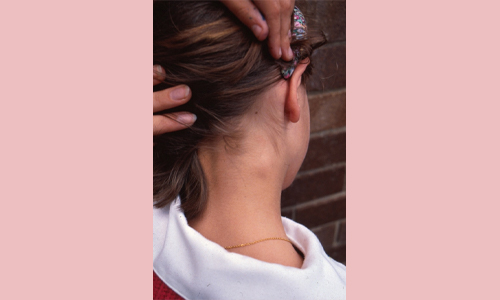 A woman with a lump behind her ear