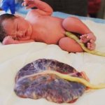 Lotus Birth: How It Works, Benefits, Risks, and Other Considerations