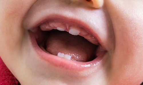 lip-tie-symptoms