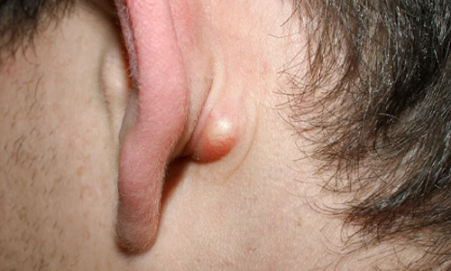 Ear Cysts