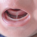 What Causes Lip Ties in Babies and How to Treat Them?