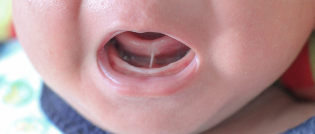 What Causes Lip Ties in Babies and How to Treat Them?