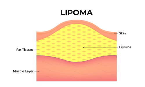 Lipoma