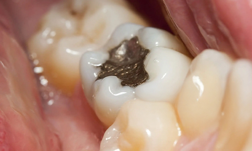 Sliver Fillings for teeth