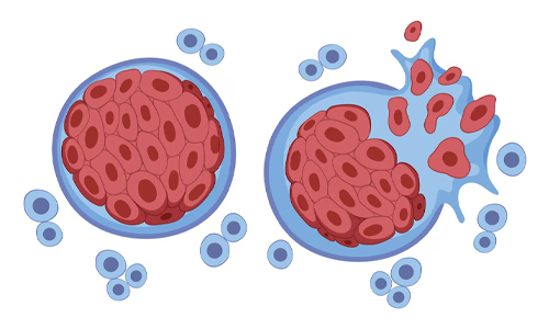 Tumors