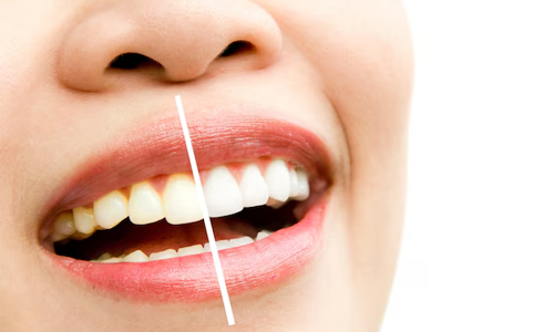 About Discolored Teeth