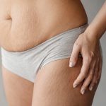 5 Myths About Cellulite
