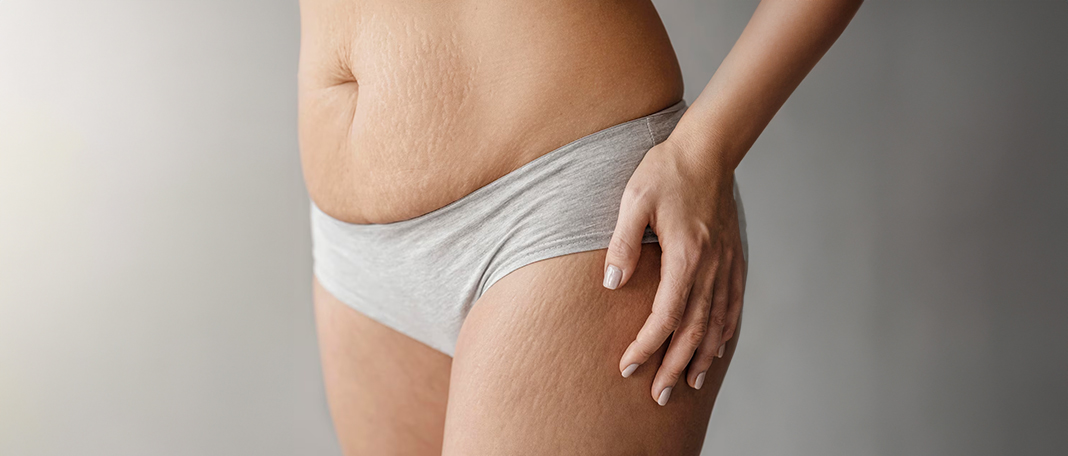 5 Myths About Cellulite