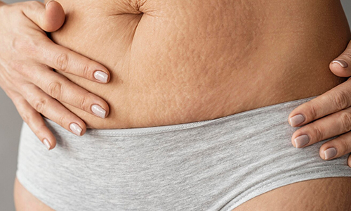 Only-Overweight-People-Get-Cellulite