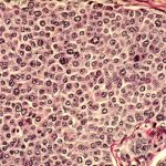 All You Should Know About Precancerous Cells