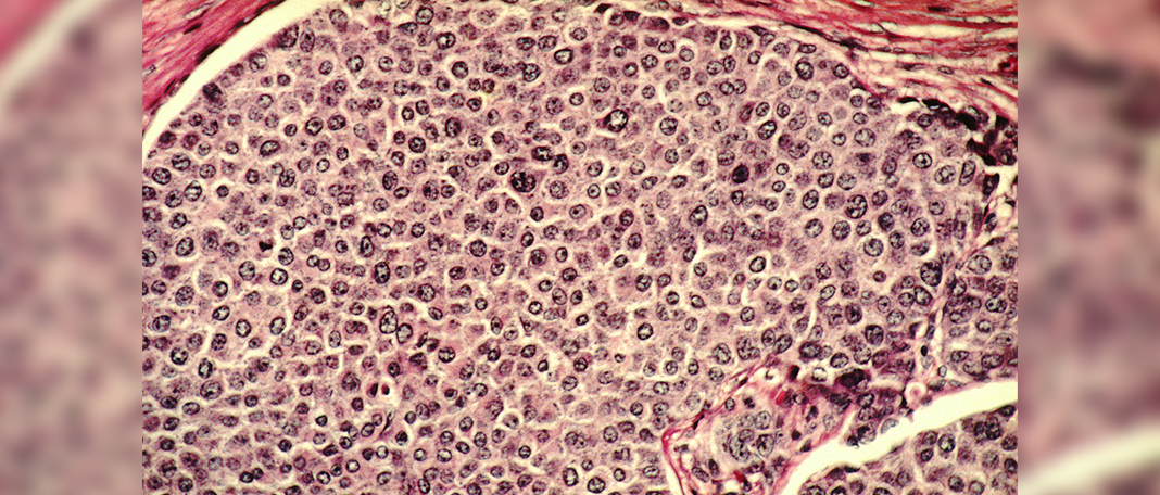 All You Should Know About Precancerous Cells