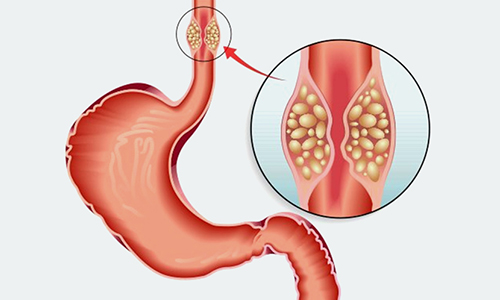 Precancerous-Cells-in-the-Esophagus