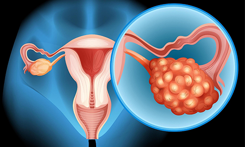 Precancerous-Ovarian-Cells