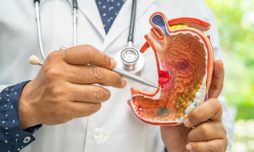 Precancerous-Cells-in-the-Stomach