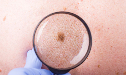 Precancerous-Cells-on-the-Skin