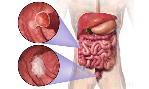 Precancerous-Cells-in-the-Colon